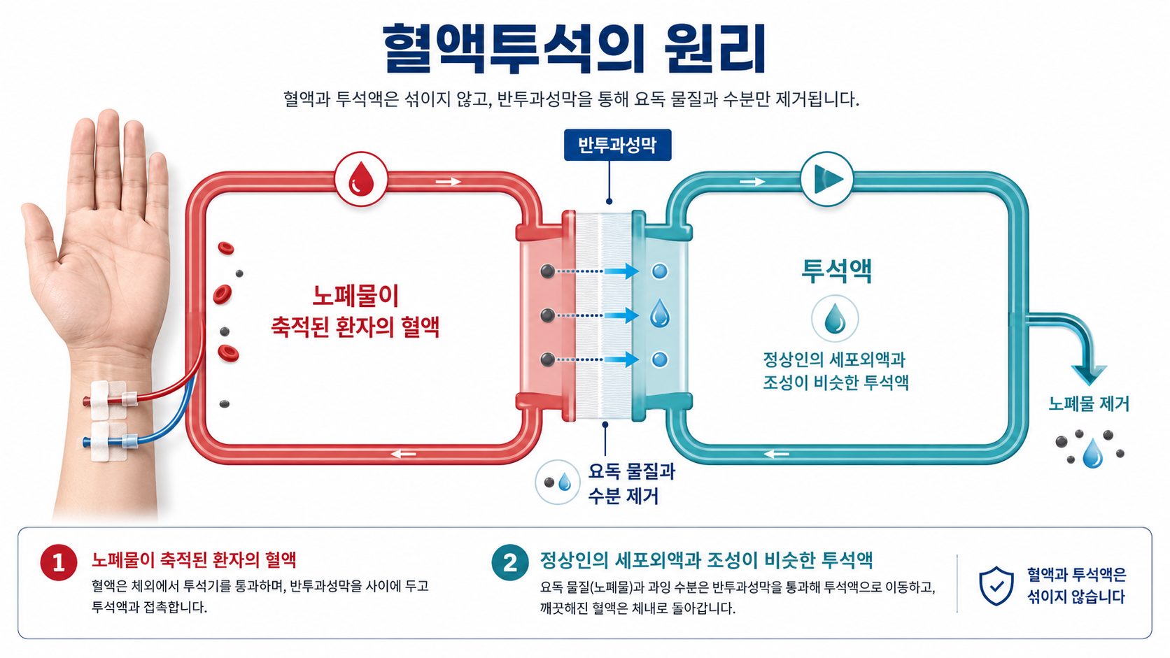 혈액투석.png